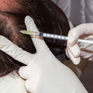Haartransplantation