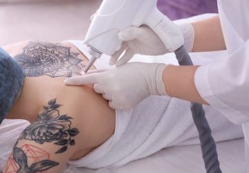 Tattoos entfernen