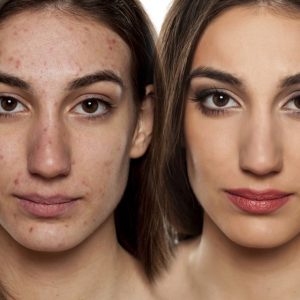 Make-up für Problemhaut