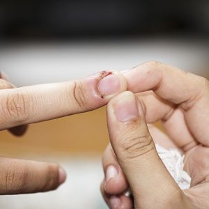 Nagelbettentzündung