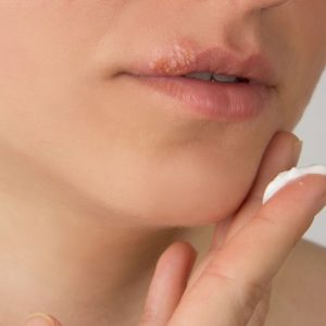 Lippenherpes