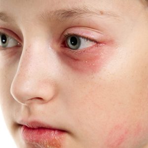 Stewardessen-Krankheit