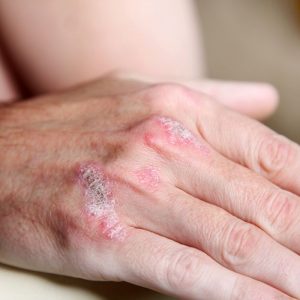 Psoriasis