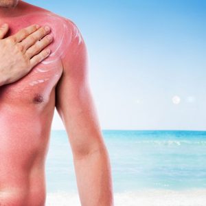 Tipps zum Schutz vor Sonnenbrand.