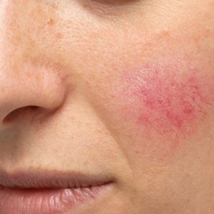Rosacea