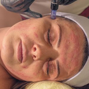 Microneedling