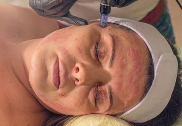 Microneedling