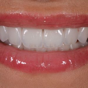 Aligner aus dem Internet