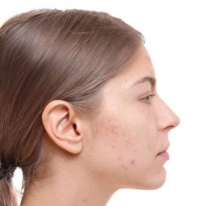 Behandlungen von Narben